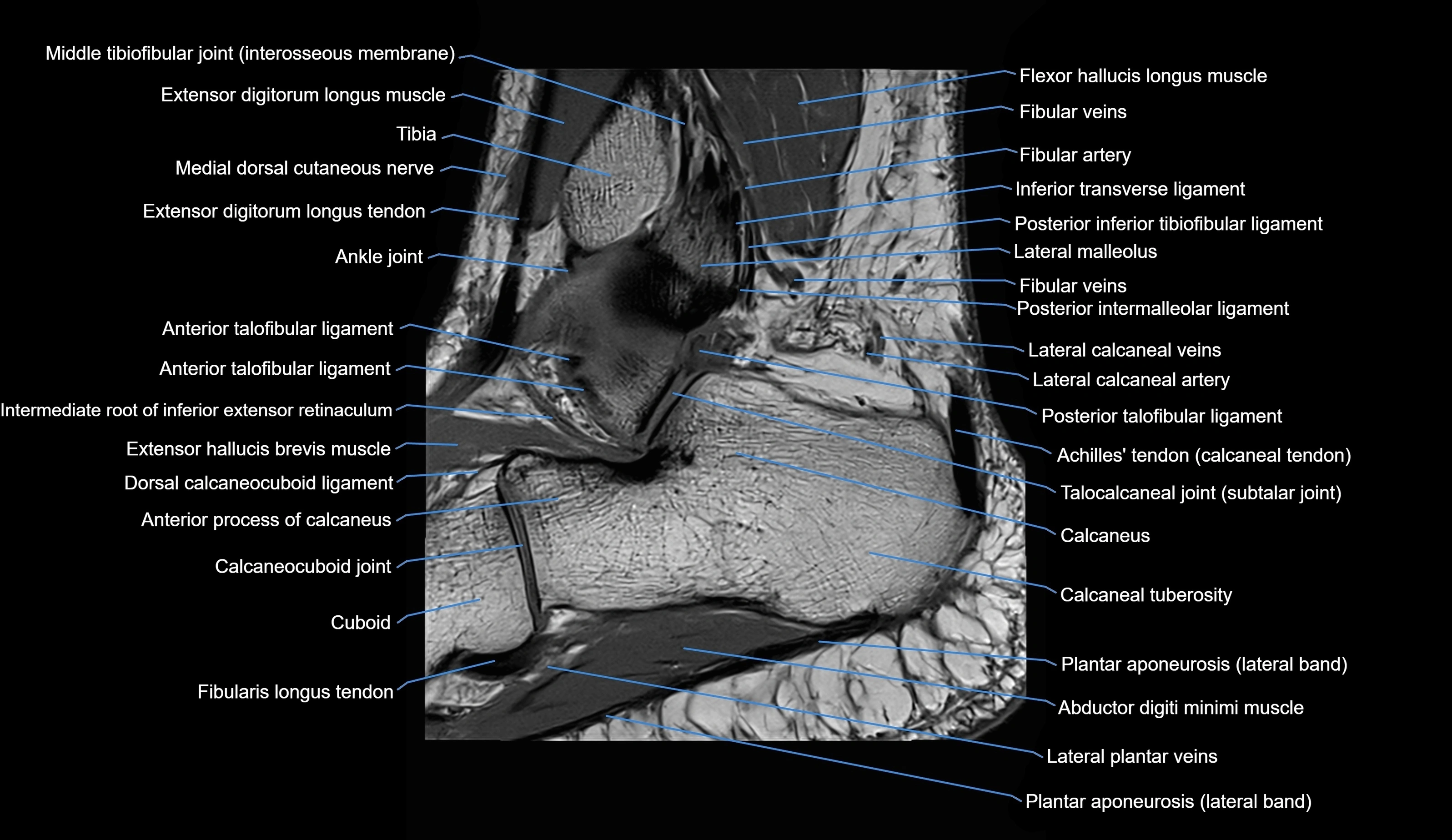MRI Ankle sagittal cross sectional anatomy 3T  radiology  image-img-00001-00025.webp